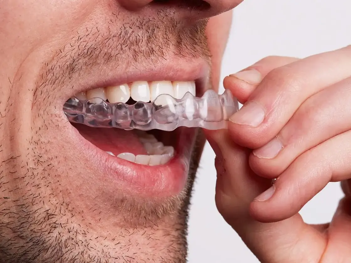 Person fitting a clear 3D printed night guard